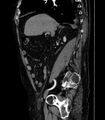 Abdominal aortic aneurysm (Radiopaedia 25855-26001 Sagittal C+ arterial phase 6).jpg