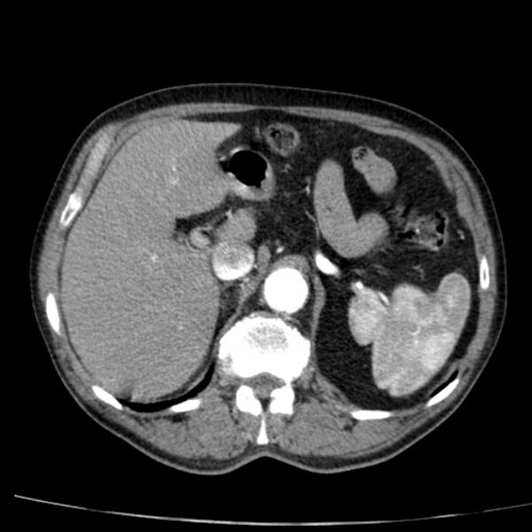 File:Abdominal aortic aneurysm (Radiopaedia 29248-29660 Axial C+ arterial phase 20).jpg