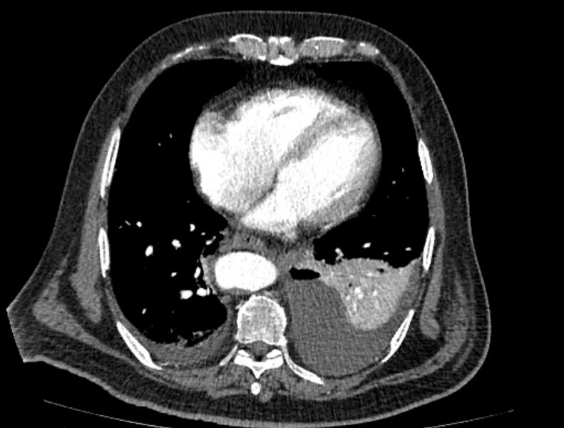 File:Abdominal aortic aneurysm rupture (Radiopaedia 54179-60362 Axial C+ arterial phase 15).jpg