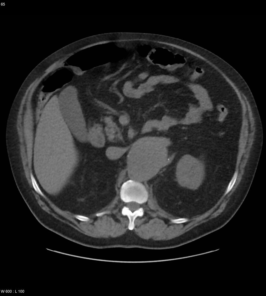 Abdominal aortic aneurysm with intramural hematoma then rupture (Radiopaedia 50278-55631 Axial non-contrast 61).jpg