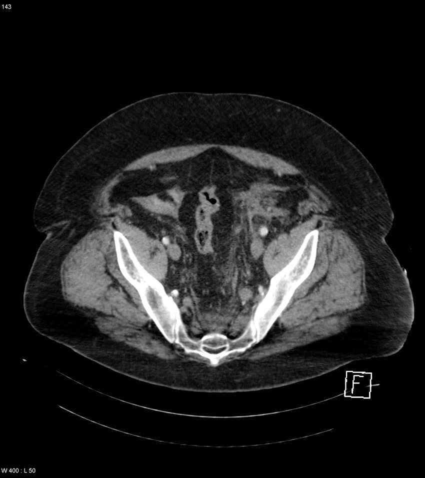 Abdominal aortic aneurysm with intramural hematoma then rupture (Radiopaedia 50278-55632 Axial C+ arterial phase 142).jpg