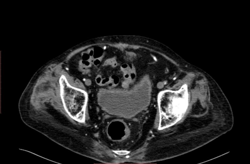File:Abdominal aortic interposition tube graft and aneurysm thrombosis (Radiopaedia 71438-81857 Axial C+ arterial phase 210).jpg