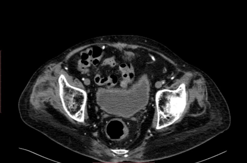 Abdominal aortic interposition tube graft and aneurysm thrombosis (Radiopaedia 71438-81857 Axial C+ arterial phase 210).jpg