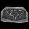 Abdominal wall endometriosis (Radiopaedia 83702-98847 Axial T1 8).jpg