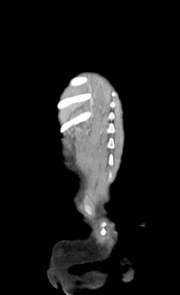 File:Abdominopelvic rhabdomyosarcoma (Radiopaedia 78356-90984 Coronal C+ portal venous phase 84).jpg