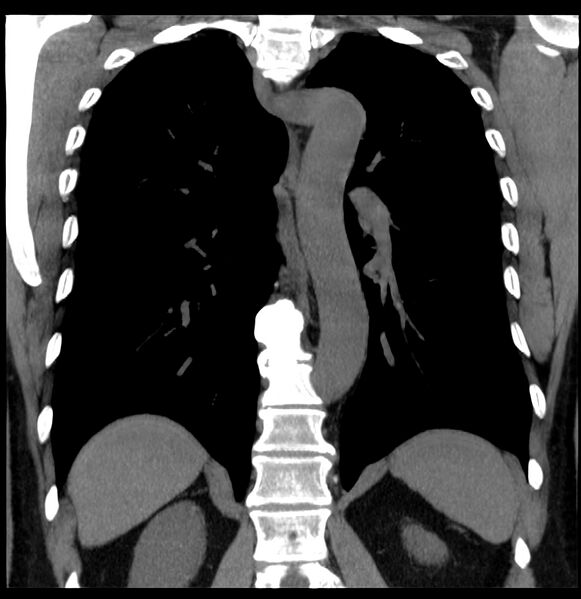 File:Aberrant right subclavian artery (Radiopaedia 40967-43680 Coronal non-contrast 25).jpg
