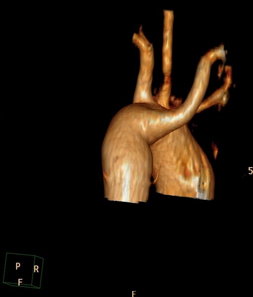 File:Aberrant right subclavian artery (Radiopaedia 67135-76475 volume rendering C+ arterial phase 15).jpg