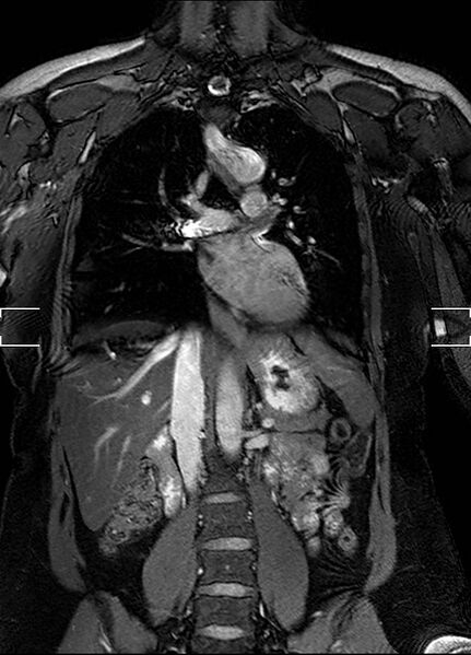 File:Aberrant right subclavian artery with background Takayasu arteritis (Radiopaedia 21423-21363 Coronal MRA 15).jpg
