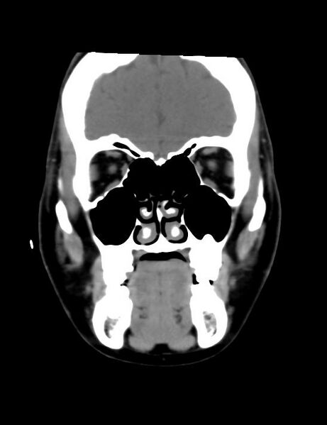 File:Accessory parotid glands (Radiopaedia 27289-27472 Coronal non-contrast 19).jpg