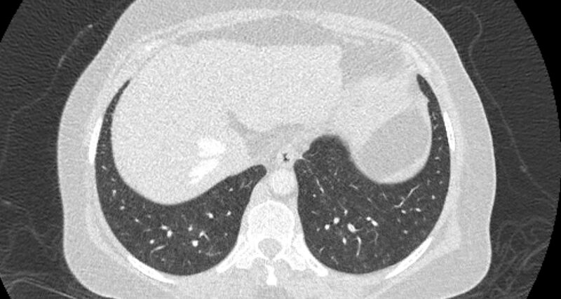 File:Accessory right inferior hepatic vein (Radiopaedia 65245-74259 Axial lung window 64).jpg