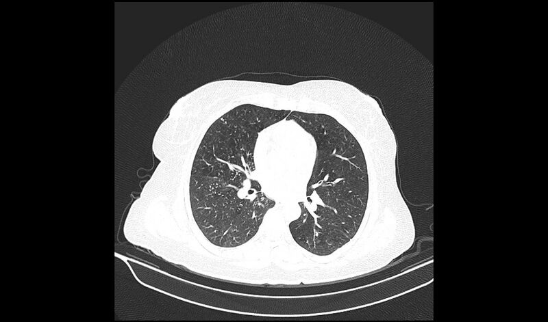 File:Acquired tracheo-esophageal fistula (Radiopaedia 51356-57103 Axial lung window 23).jpg
