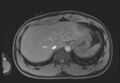 Active right ventricular cardiac sarcoidosis (Radiopaedia 55596-62100 Axial Post contrast Dixon 71).jpg