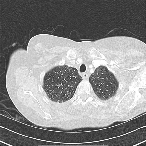 File:Acute-on-chronic pulmonary emboli (Radiopaedia 27925-28169 lung window 7).jpg
