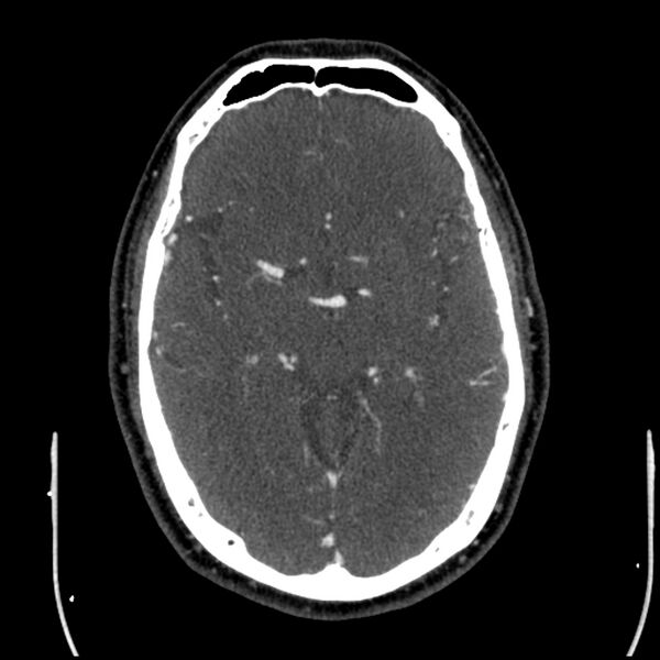 File:Acute A3 occlusion with ACA ischemic penumbra (CT perfusion) (Radiopaedia 72036-82527 Axial C+ arterial phase thins 86).jpg