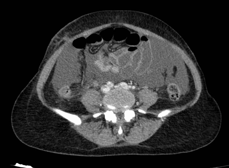 File:Acute Budd-Chiari syndrome (Radiopaedia 60858-68638 Axial C+ portal venous phase 199).jpg