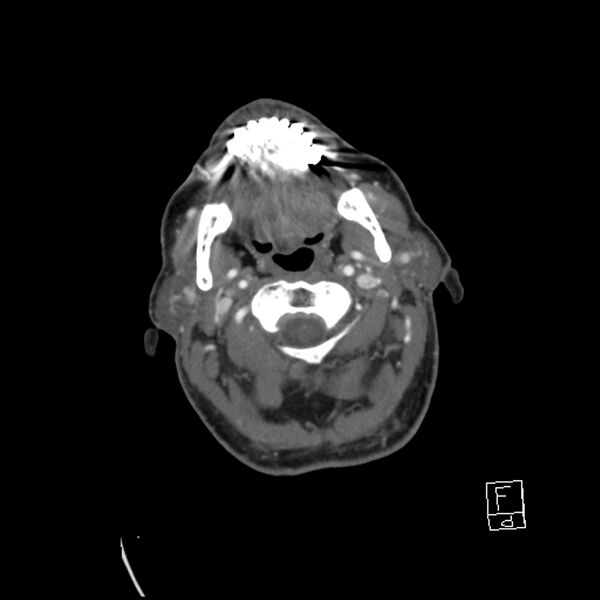 File:Acute ICA ischemic penumbra due to high-grade CCA stenosis (CT perfusion) (Radiopaedia 72038-82530 Axial C+ arterial phase 32).jpg