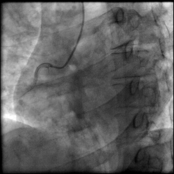 File:Acute anteroseptal myocardial infarction (Radiopaedia 68409-77946 RAO straight RCA 8).jpg