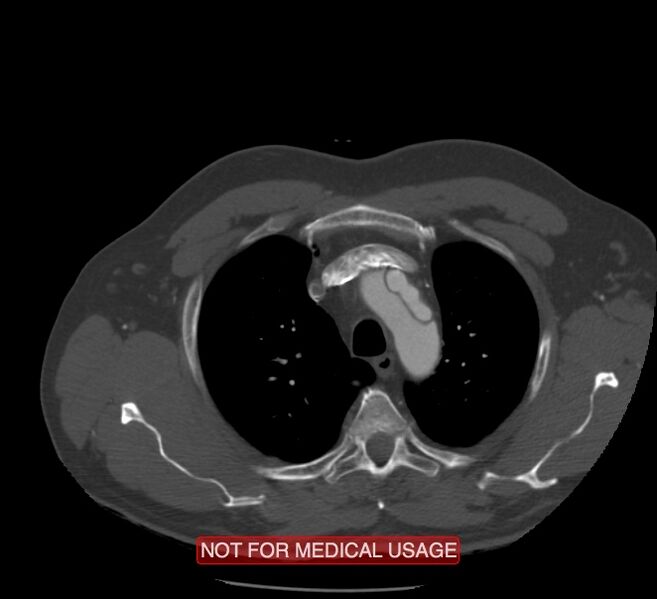 File:Acute aortic dissection - Stanford type A (Radiopaedia 40661-43285 Axial C+ arterial phase 2).jpg