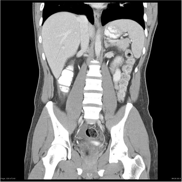 File:Acute appendicitis (Radiopaedia 25364-25615 C+ portal venous phase 17).jpg