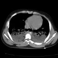 Acute aspiration pneumonitis (Radiopaedia 33605-34703 Axial non-contrast 58).jpg