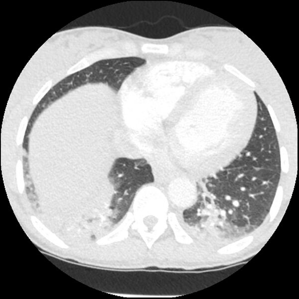 File:Acute chest syndrome - sickle cell disease (Radiopaedia 42375-45499 Axial lung window 143).jpg