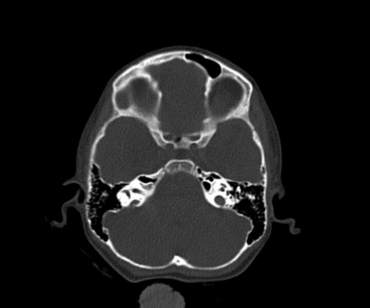 File:Acute epidural hematoma (Radiopaedia 63659-72335 Axial bone window 6).jpg