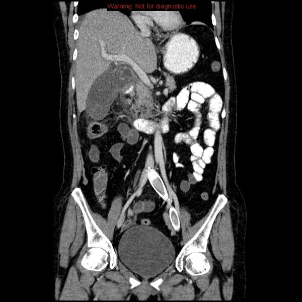 File:Acute gangrenous cholecystitis (Radiopaedia 10123-10661 Coronal C+ portal venous phase 14).jpg