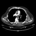 Acute heart failure (CT) (Radiopaedia 79835-93075 Axial C+ arterial phase 12).jpg