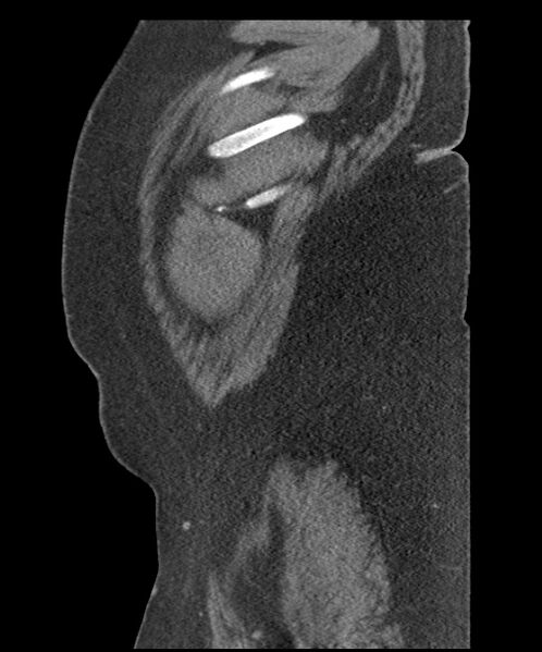 File:Acute mesenteric venous ischemia (Radiopaedia 46041-50383 Sagittal C+ portal venous phase 6).jpg