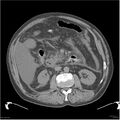 Acute pancreatitis (Radiopaedia 19135-19116 Axial non-contrast 22).jpg
