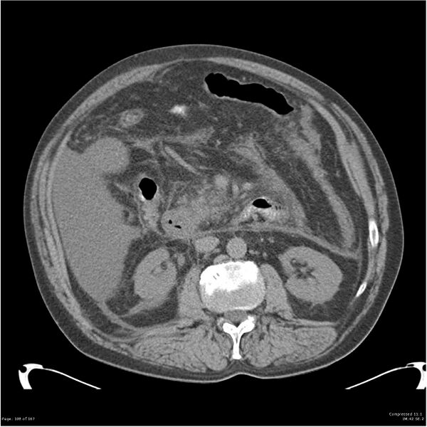 File:Acute pancreatitis (Radiopaedia 19135-19116 Axial non-contrast 22).jpg
