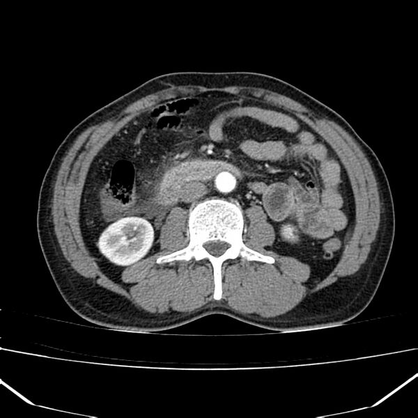File:Acute pancreatitis (Radiopaedia 22572-22596 Axial C+ arterial phase 39).jpg