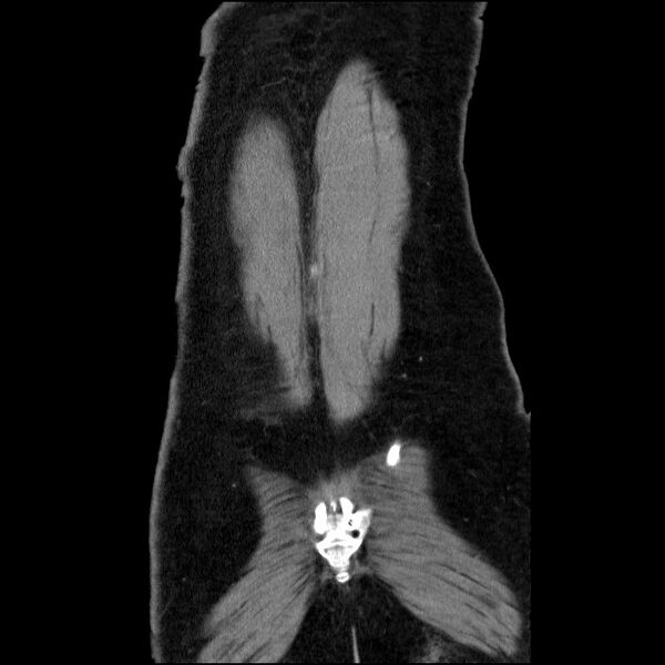 File:Acute pancreatitis (Radiopaedia 69236-79012 Coronal C+ portal venous phase 15).jpg