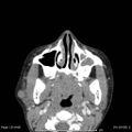 Acute parotitis (Radiopaedia 54123-60294 Axial C+ arterial phase 1).jpg