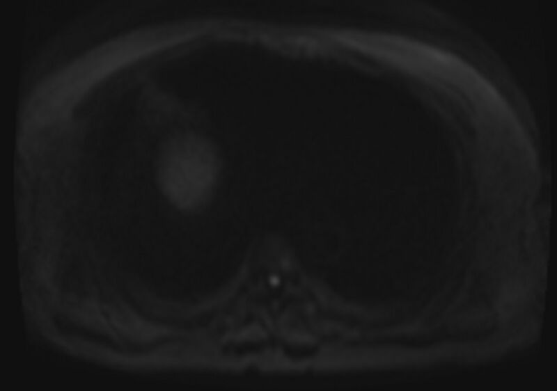 File:Acute portal vein thrombosis (Radiopaedia 73198-83925 Axial DWI 64).jpg