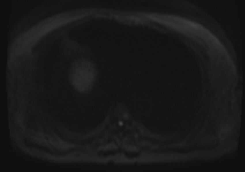 Acute portal vein thrombosis (Radiopaedia 73198-83925 Axial DWI 64).jpg