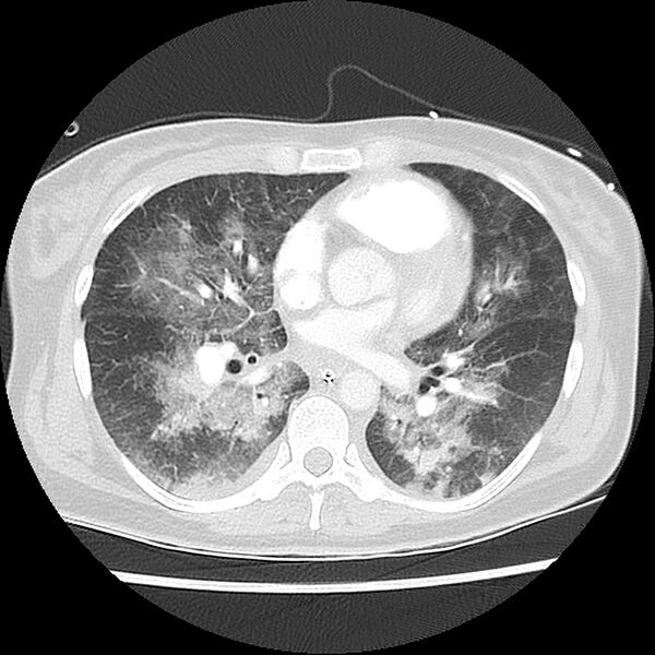 File:Acute pulmonary edema on CT (Radiopaedia 33582-34672 Axial lung window 30).jpg