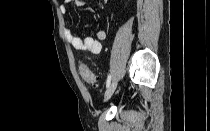 File:Acute sigmoid colon diverticulitis (Radiopaedia 55507-61976 Sagittal C+ portal venous phase 58).jpg