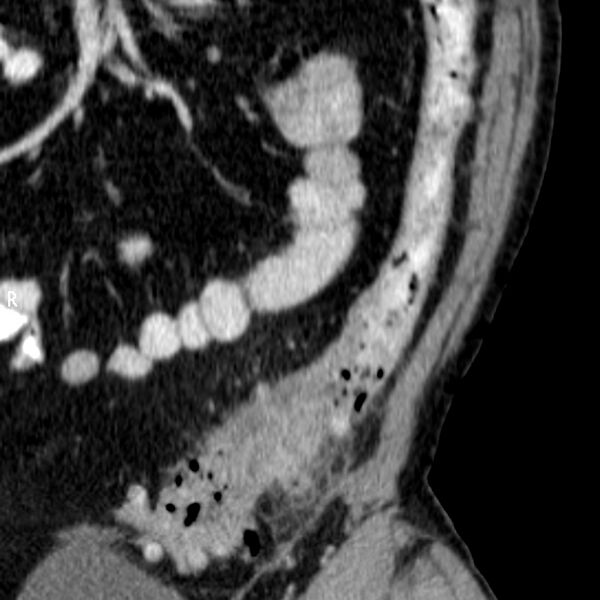 File:Acute sigmoid colon diverticulitis (Radiopaedia 55507-61977 curved MPR C+ portal venous phase 1).jpg