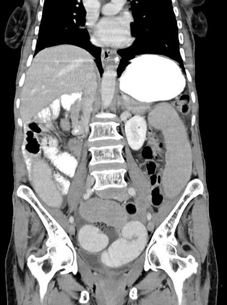 File:Acute small bowel (ileal) volvulus (Radiopaedia 71740-82139 Coronal C+ portal venous phase 62).jpg