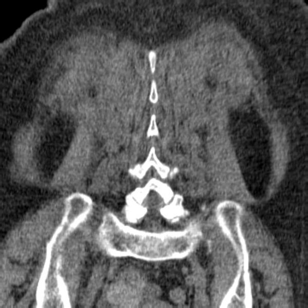 File:Acute tubular necrosis (Radiopaedia 28077-28334 Coronal non-contrast 35).jpg