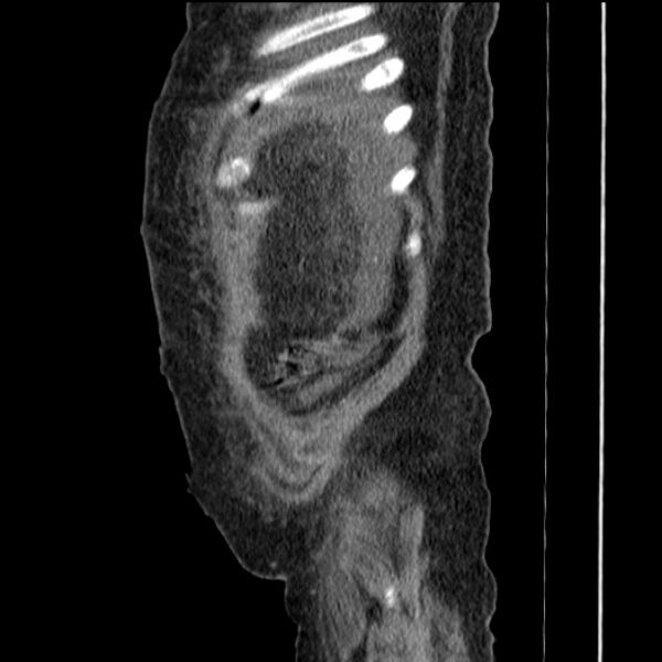 File:Acute tubular necrosis (Radiopaedia 28077-28334 H 12).jpg