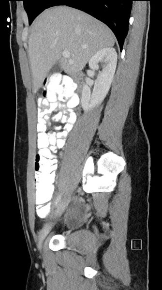 File:Acute uncomplicated appendicitis (Radiopaedia 61374-69304 Sagittal C+ portal venous phase 69).jpg
