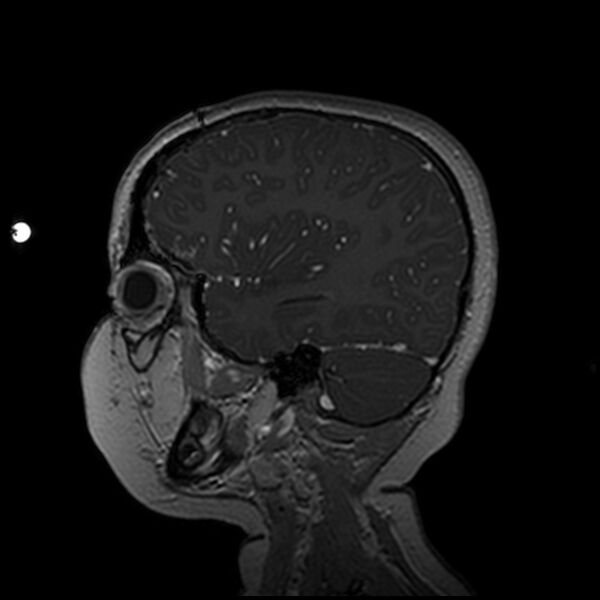 File:Adamantinomatous craniopharyngioma (Radiopaedia 77407-89529 H 91).jpg
