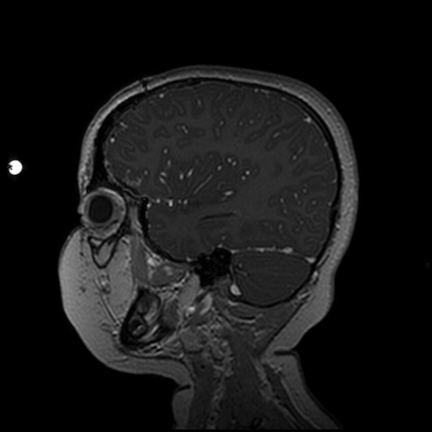 Adamantinomatous craniopharyngioma (Radiopaedia 77407-89529 H 91).jpg