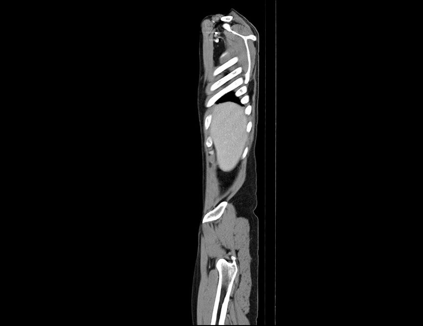 Addison disease (Radiopaedia 49318-54412 Sagittal C+ portal venous phase 63).jpg