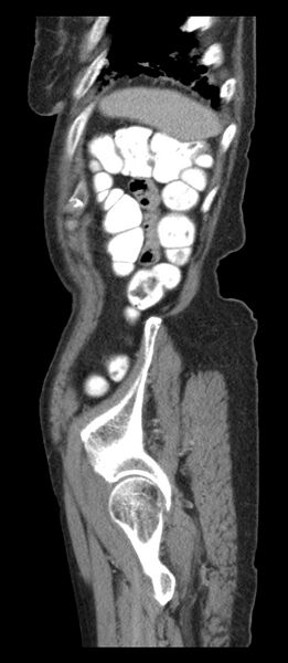 File:Adenocarcinoma of cecum (Radiopaedia 59222-66549 Sagittal C+ portal venous phase 3).jpg