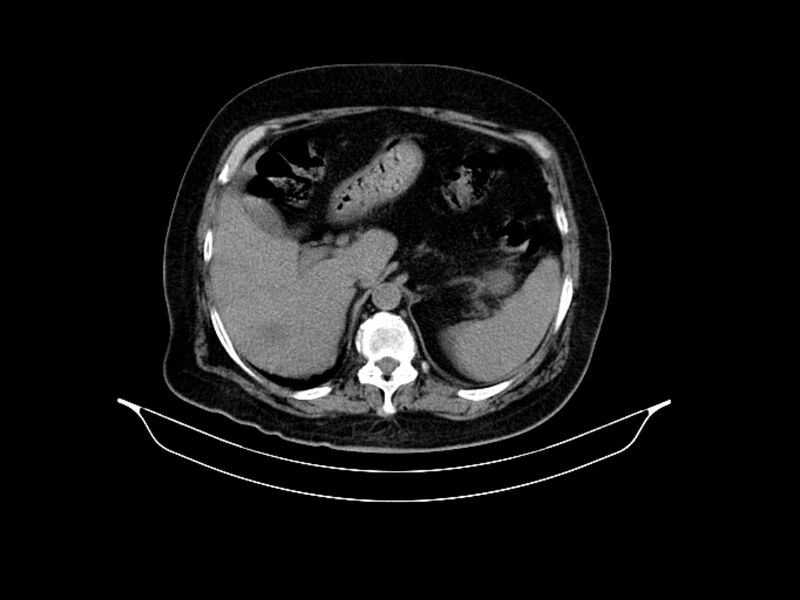 File:Adenocarcinoma of pancreas with hepatic metastasis (Radiopaedia 64332-73122 Axial non-contrast 29).jpg