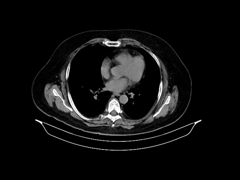 File:Adenocarcinoma of pancreas with hepatic metastasis (Radiopaedia 64332-73122 Axial non-contrast 8).jpg