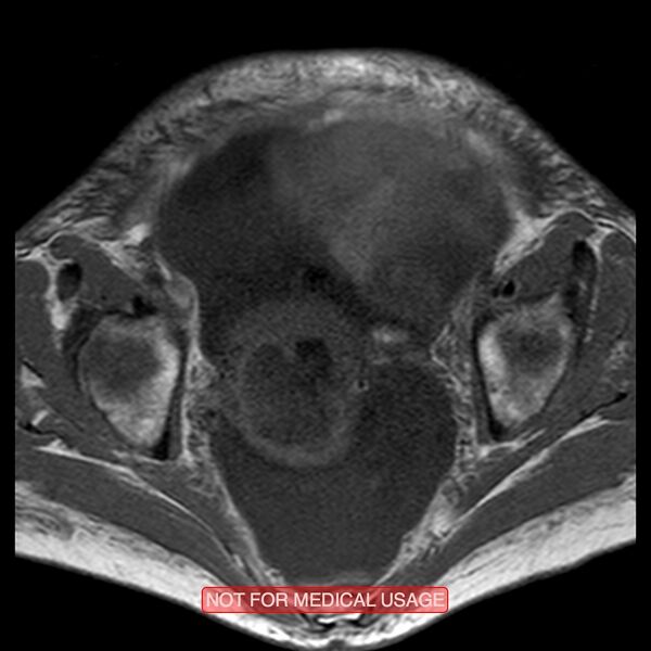 File:Adenocarcinoma of the cervix (Radiopaedia 28373-28615 Axial T1 12).jpg